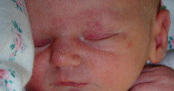 Storkebid på øjenlåg af nyfødt baby
