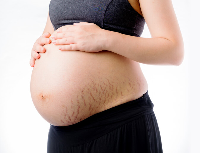 Strækmærker på gravid kvinde