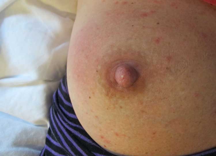 Brystbetændelse - bryst med mastitis