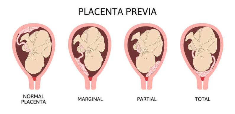 anterior-placenta-what-it-means-for-you-and-your-baby