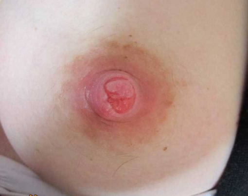 Brystvorte der er sprækker - sår på brystvorte fra amning