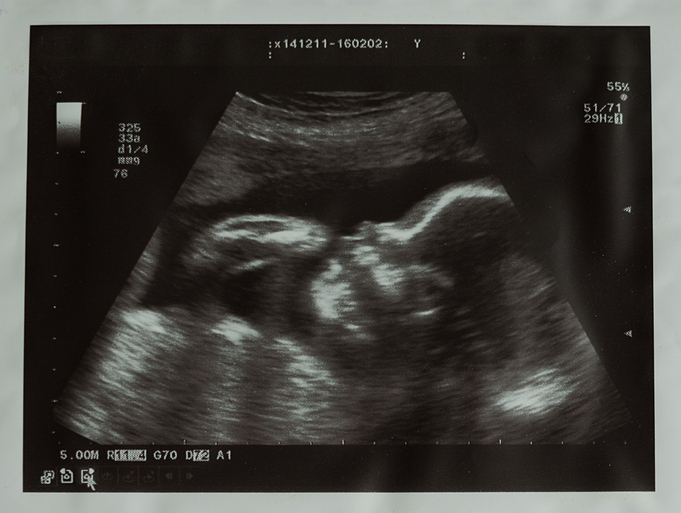 Ultrasounds foto of baby