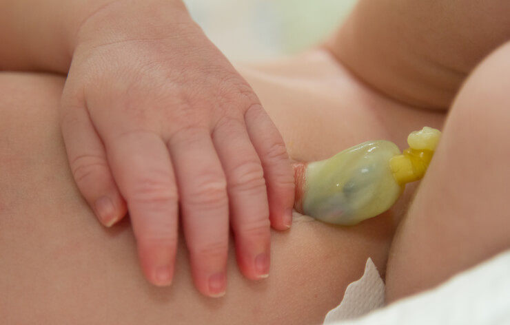 Navlestumpen med elestik på nyfødt baby