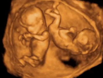 Fra 3D skanning - Tvillinger i livmoderen i uge 11+6.