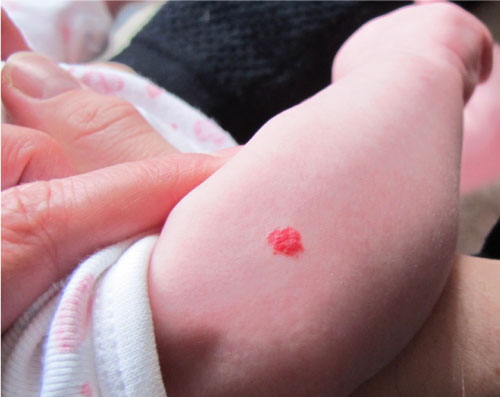 Jordbærmærke på arm af baby. 