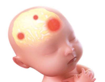 SBS - hjerneskade fra Shaken Baby Syndrome