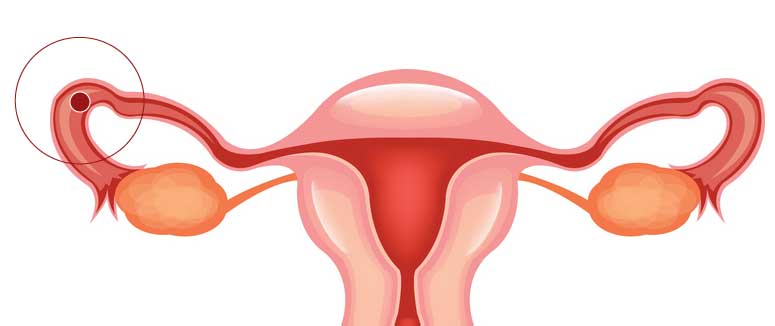 Gravid udenfor livmoderen - her sidder graviditeten udenfor livmoderen i æggelederen