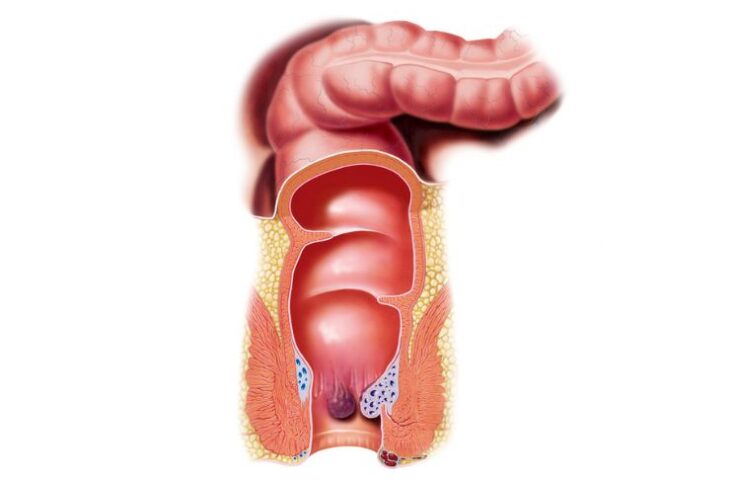 hæmoride ved endetarm