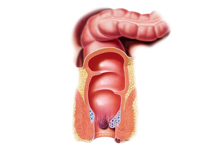 hæmoride ved endetarm