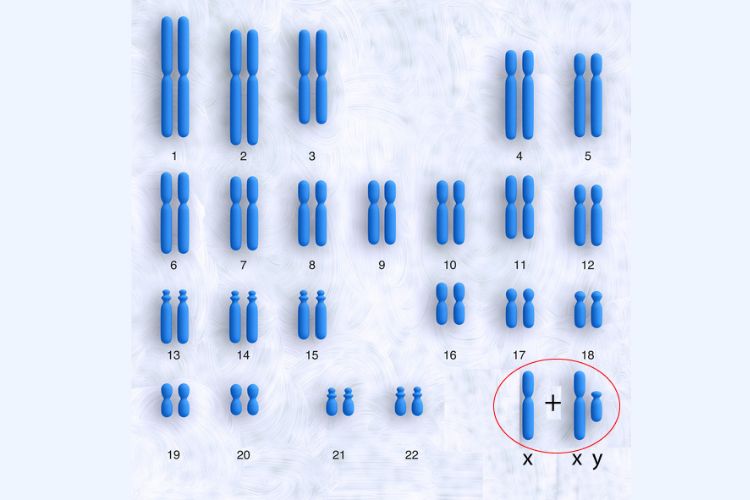 klinefelters syndrom