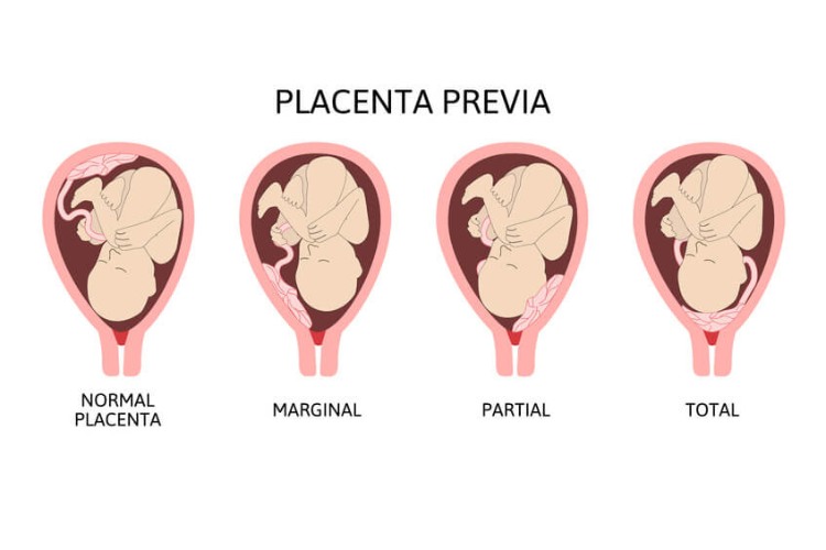 placenta-prævia.2