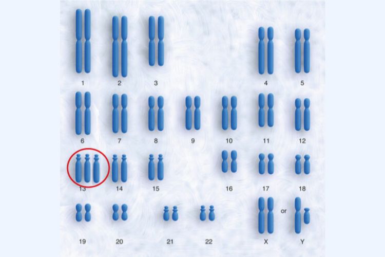 trisomi-13-q