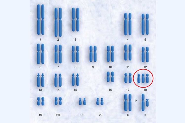 trisomi-18-q