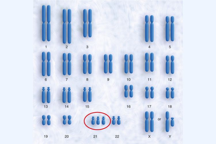 trisomi-21-q